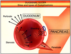 Duodenal Ulcer